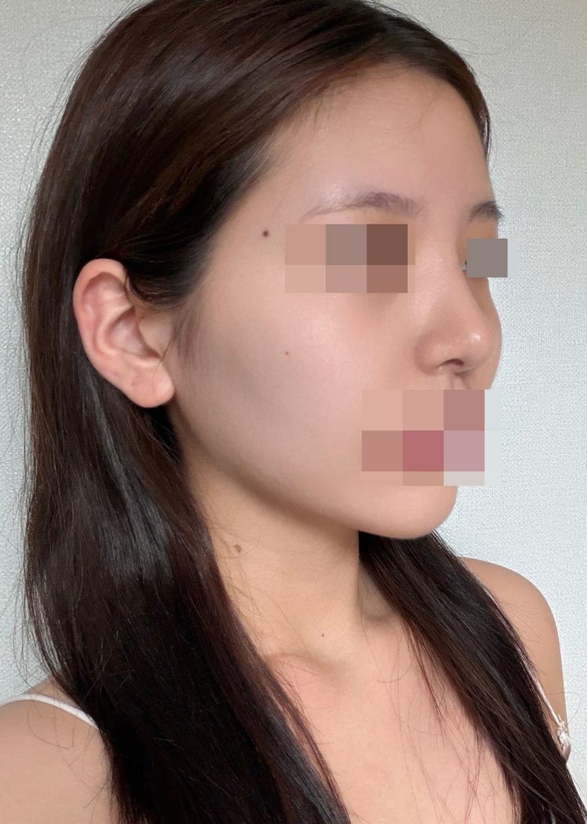 Tip plasty dengan tulang rawan sendiri