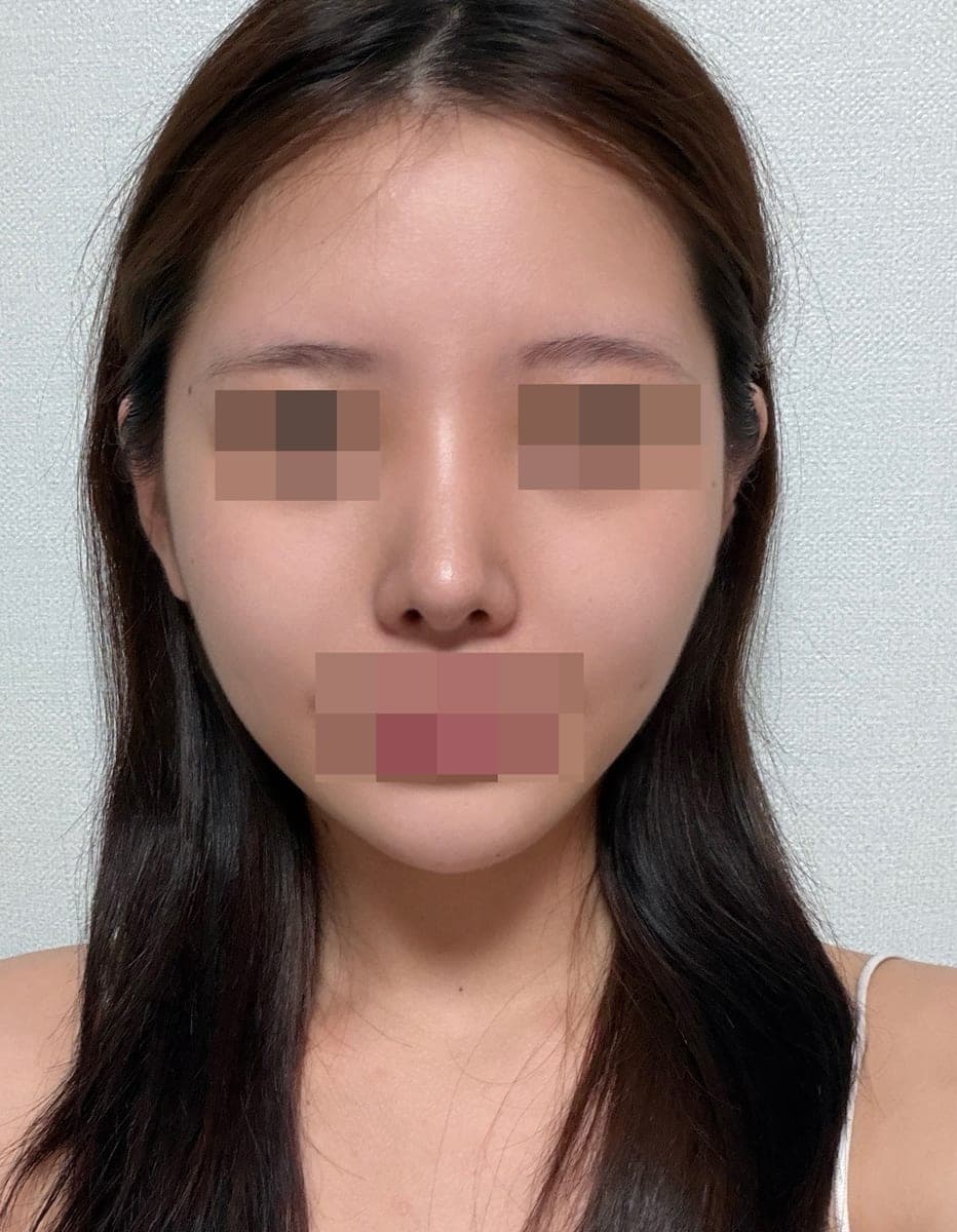Tip plasty dengan tulang rawan sendiri