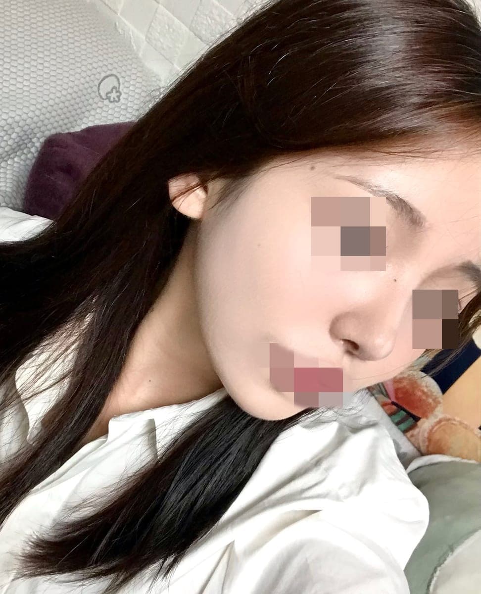 Tip plasty dengan tulang rawan sendiri
