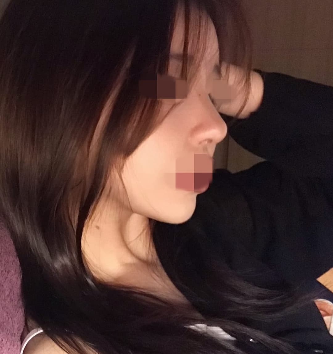 Tip plasty dengan tulang rawan sendiri