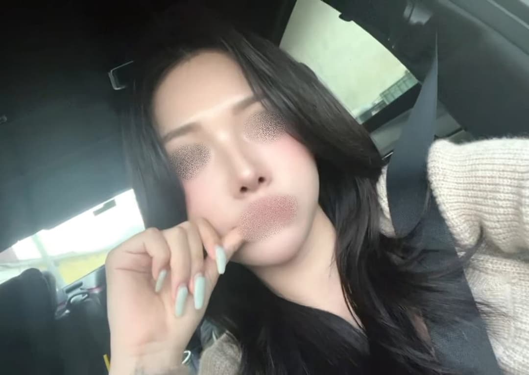 Merapatkan ujung yang melebar dengan tulang rawan donor + osteotomi