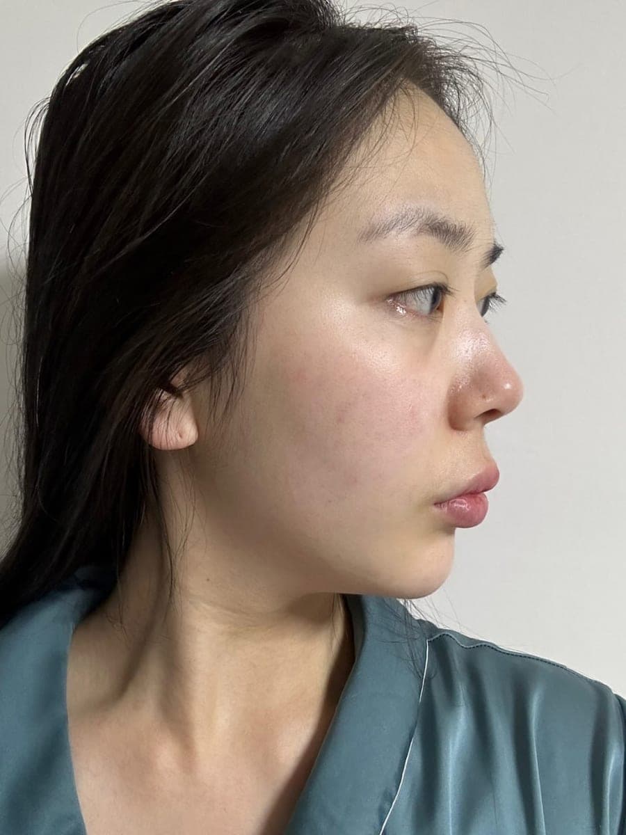 Hump reduction, tip with own cartilage