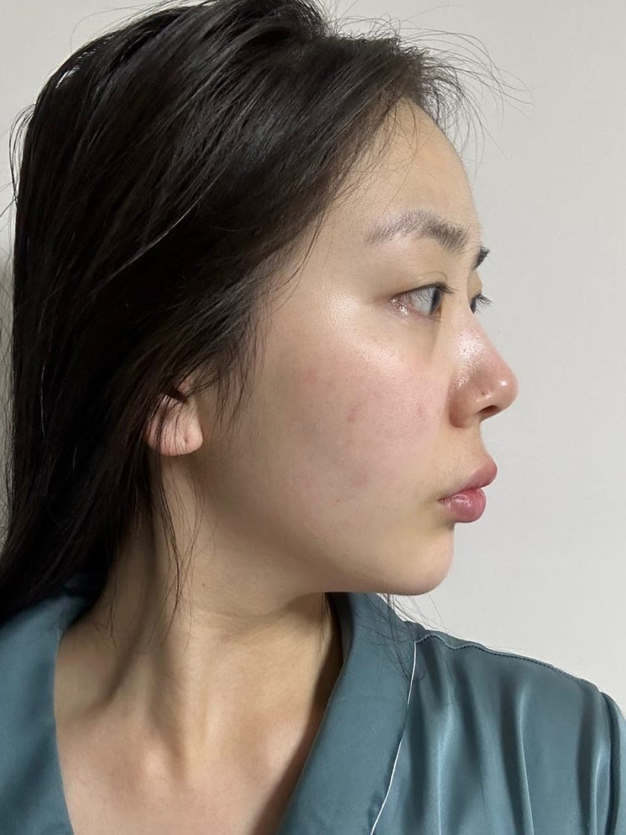Hump reduction, tip with own cartilage