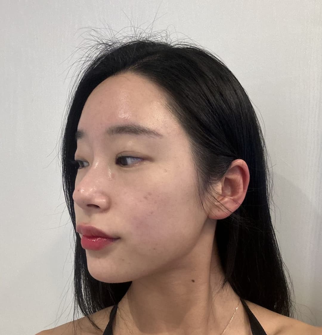 Refining the tip line with own cartilage