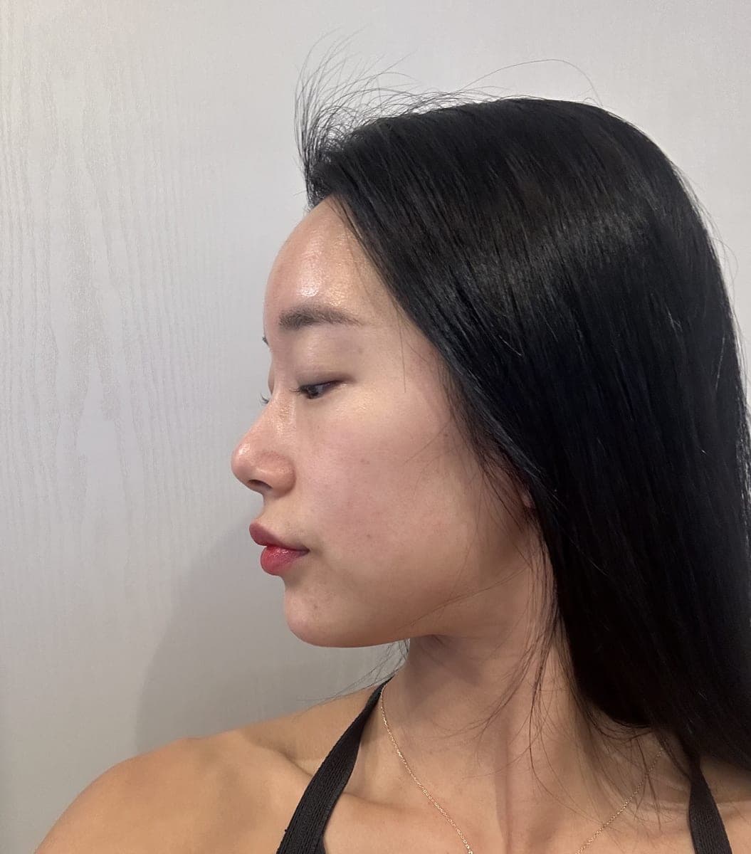 Refining the tip line with own cartilage