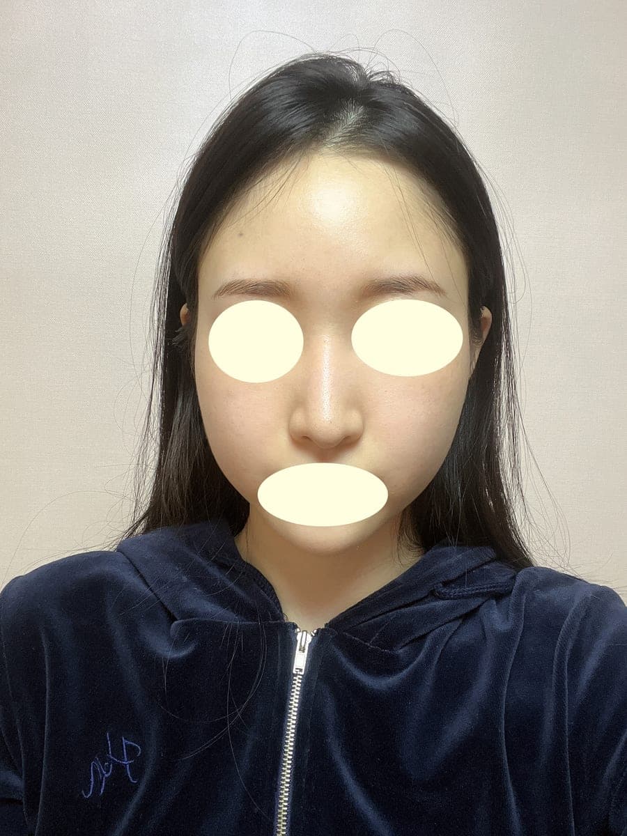 ถอดซิลิโคนแล้วสร้างใหม่ด้วยกระดูกอ่อนตัวเอง