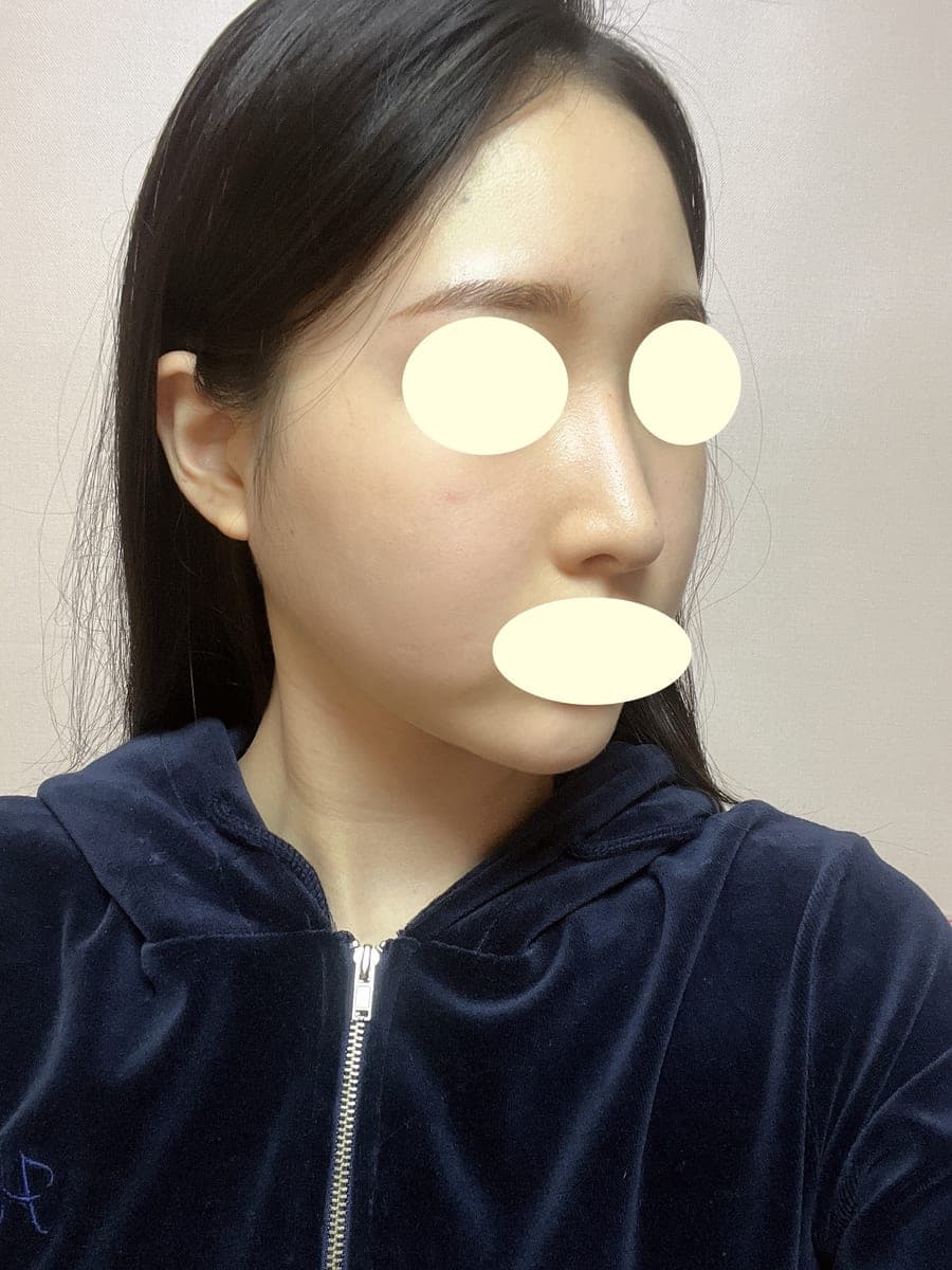 ถอดซิลิโคนแล้วสร้างใหม่ด้วยกระดูกอ่อนตัวเอง