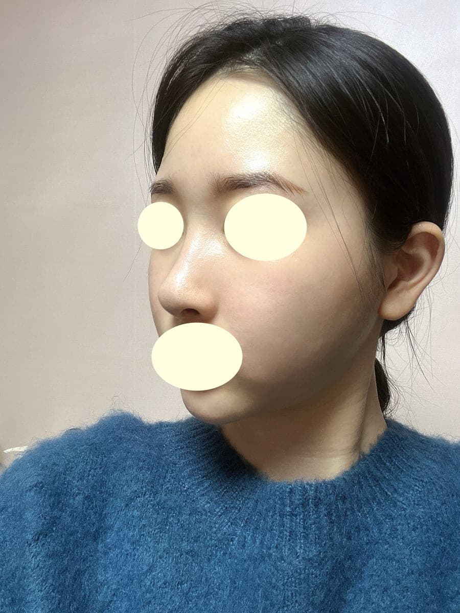 ถอดซิลิโคนแล้วสร้างใหม่ด้วยกระดูกอ่อนตัวเอง