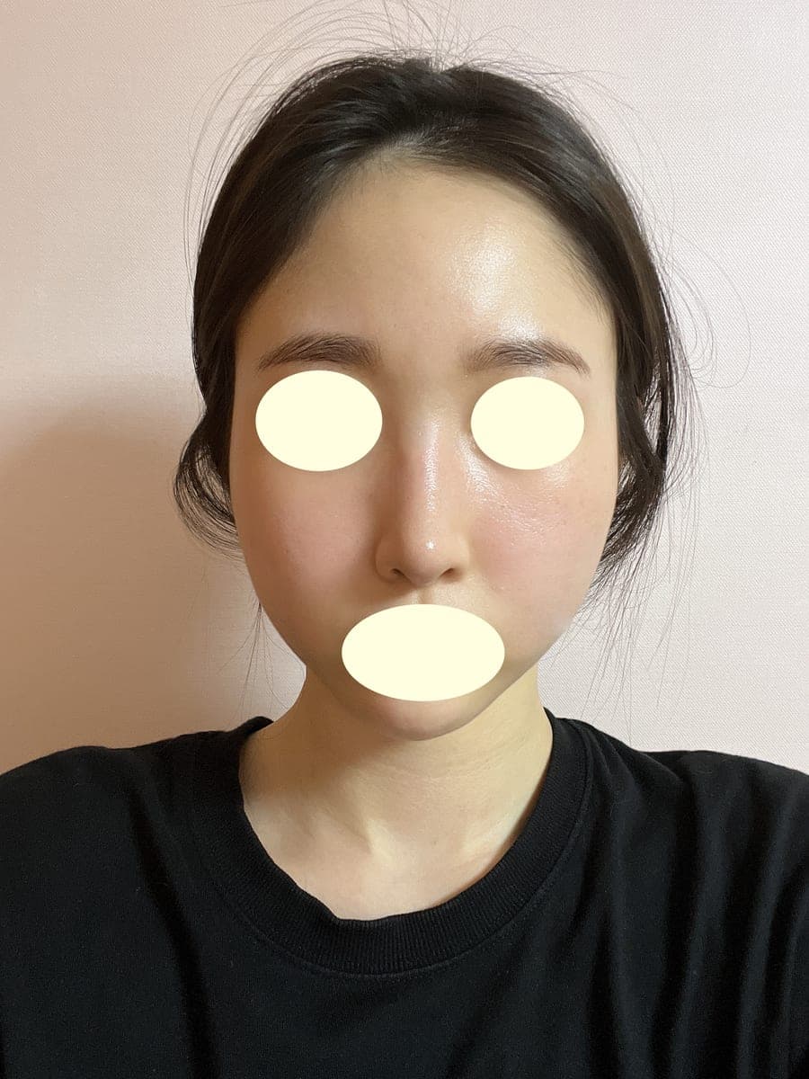 ถอดซิลิโคนแล้วสร้างใหม่ด้วยกระดูกอ่อนตัวเอง