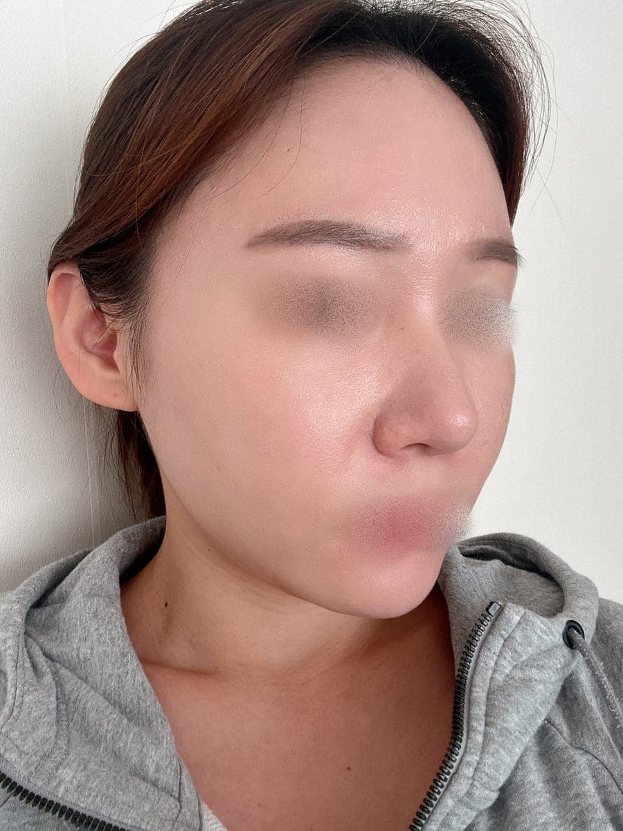 จัดเส้นจมูกใหม่ด้วยการแก้