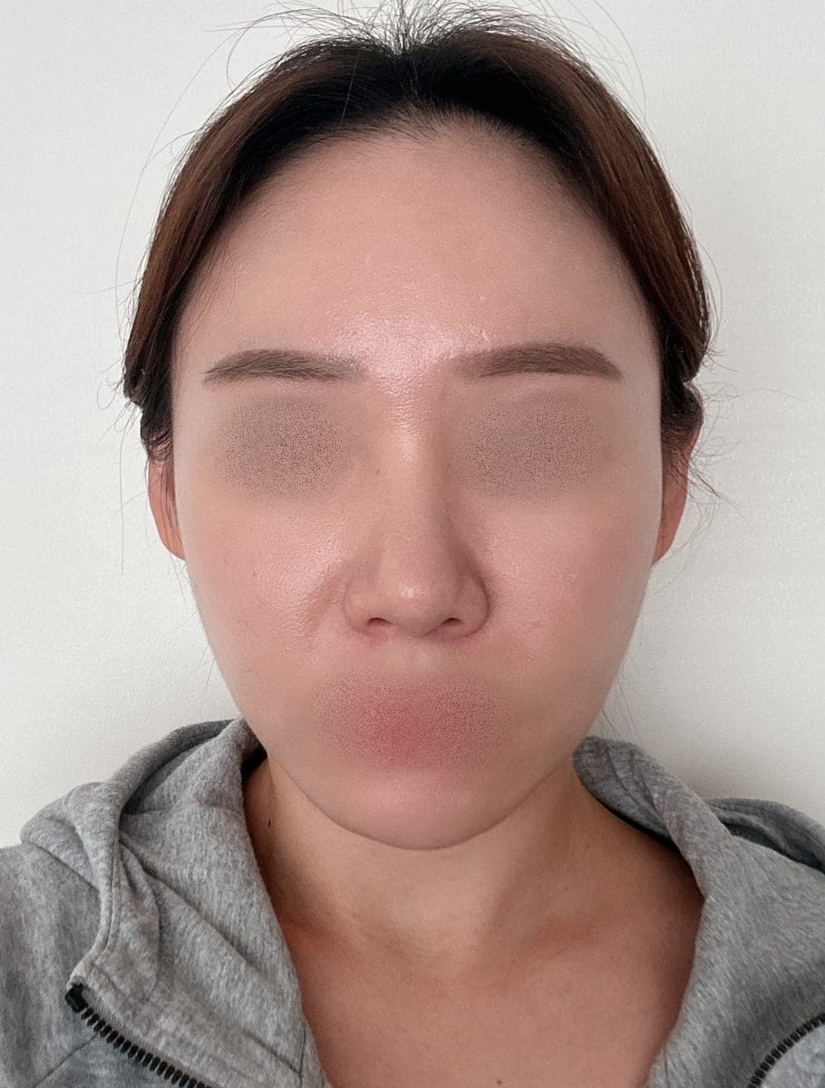 จัดเส้นจมูกใหม่ด้วยการแก้