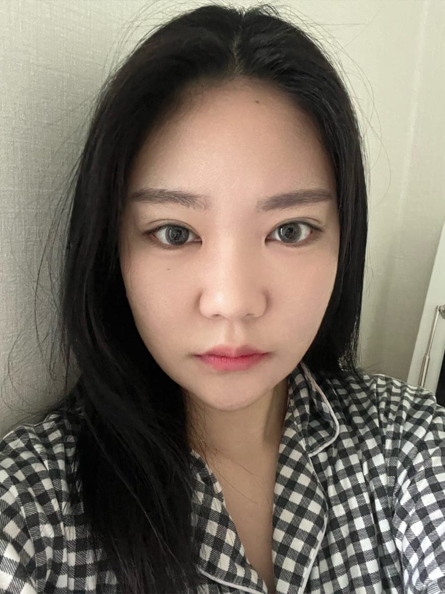 Less visible nostrils, tip with donor cartilage + osteotomy
