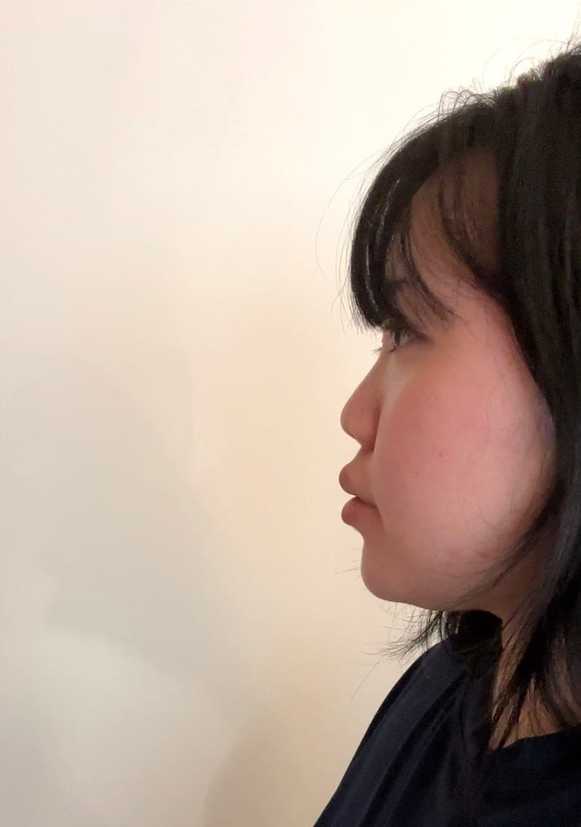 A short nose case + osteotomy