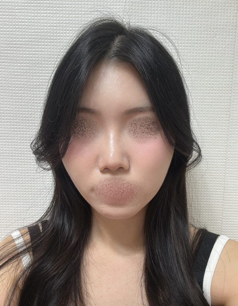 Menata ulang garis samping wajah + osteotomi