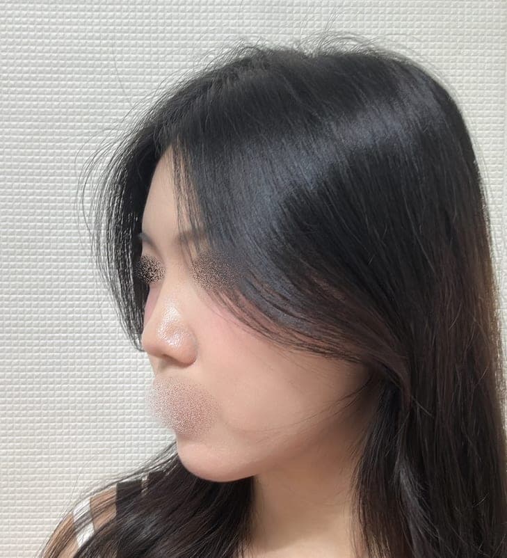Menata ulang garis samping wajah + osteotomi