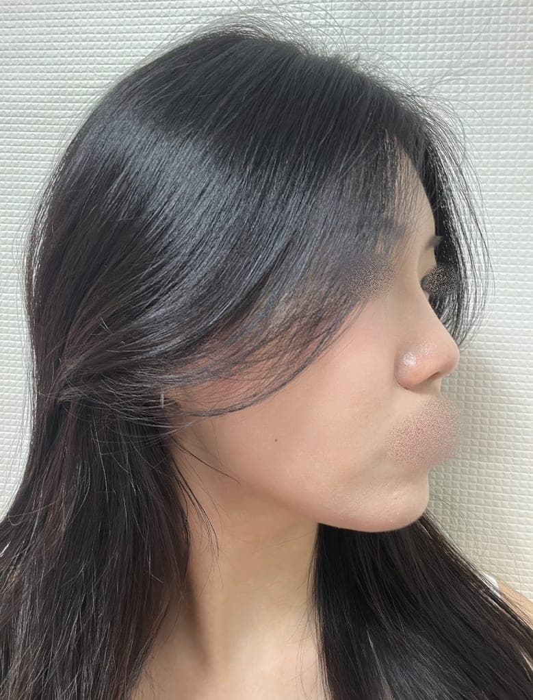 Menata ulang garis samping wajah + osteotomi