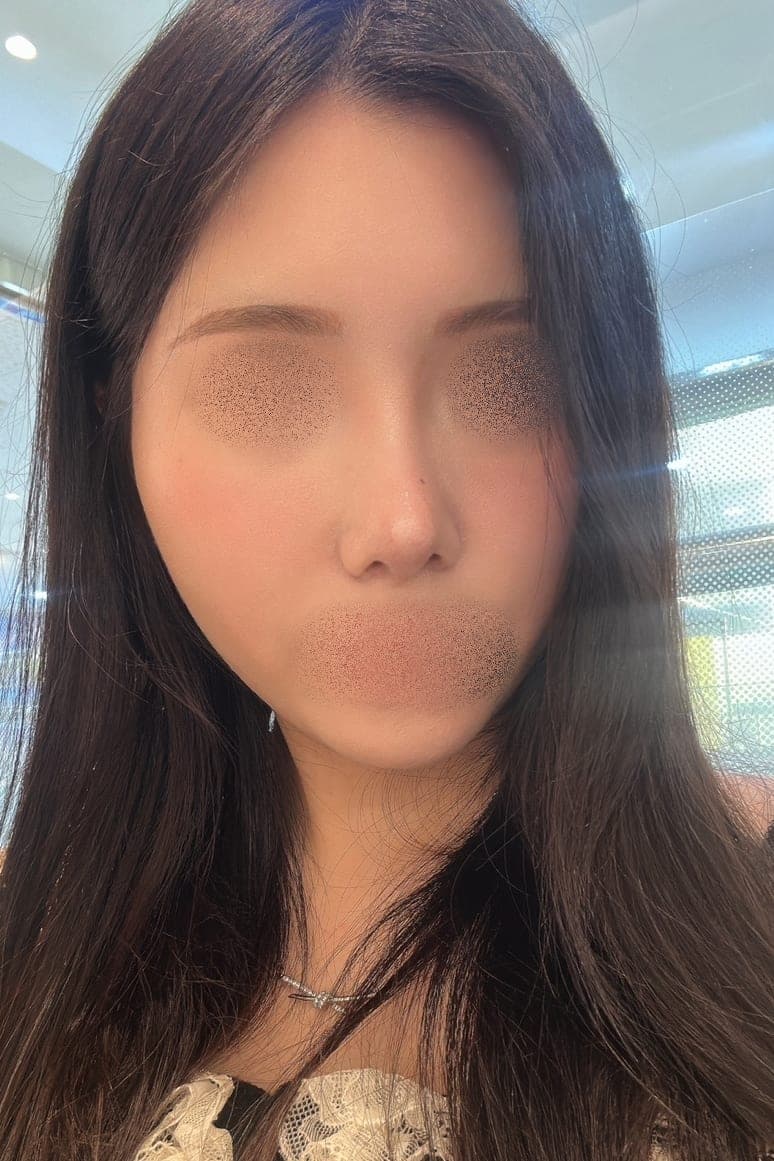 Menata ulang garis samping wajah + osteotomi