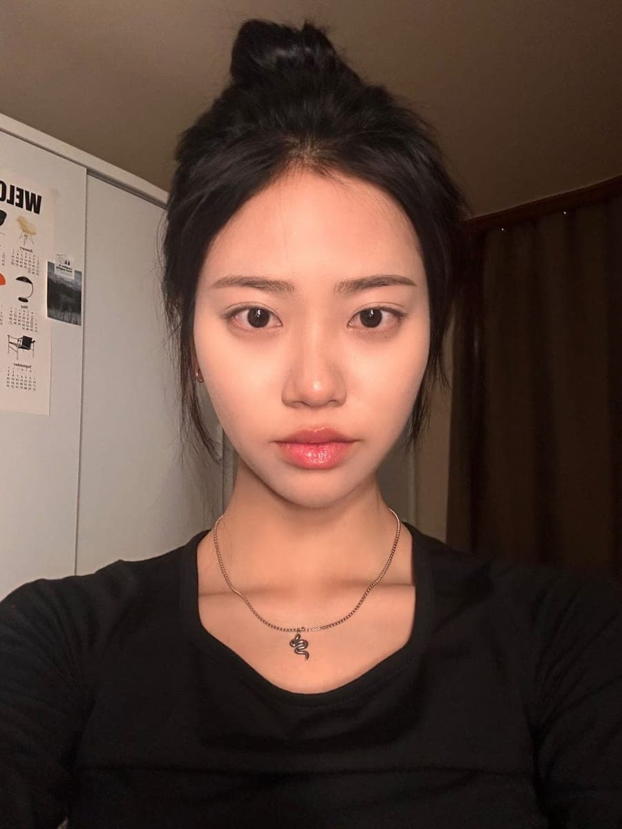 เสริมสันจมูกด้วยกระดูกอ่อนตัวเอง