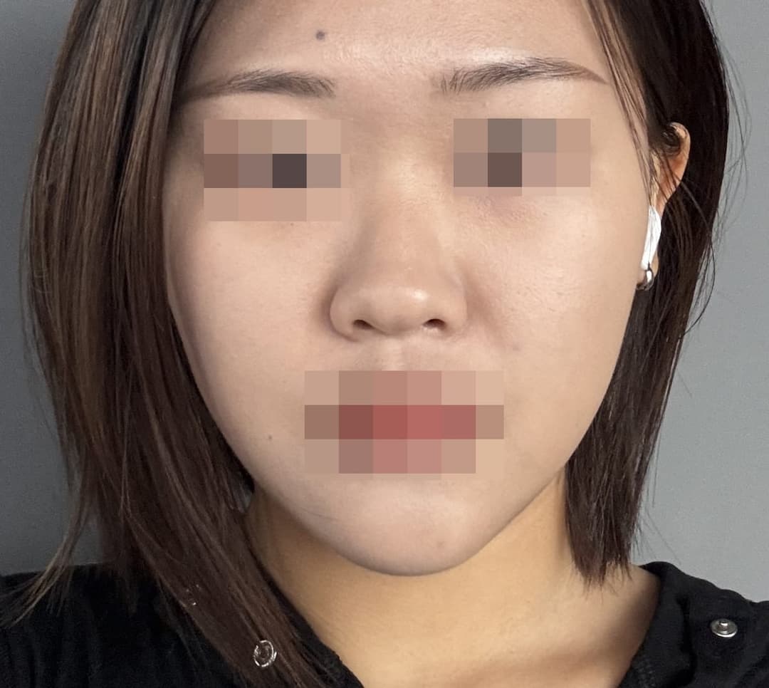 Kasus ujung bulbous dan ujung hidung sekaligus