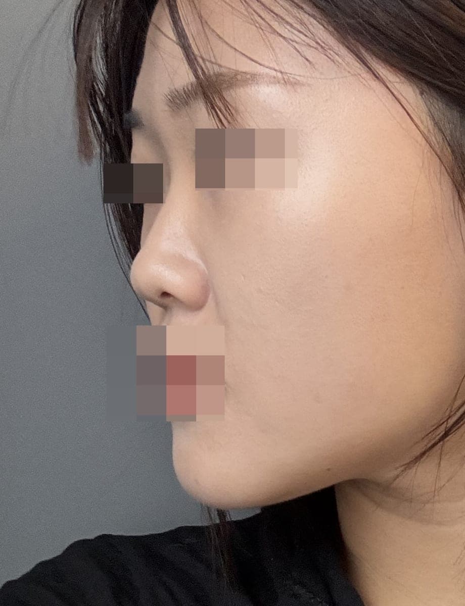 Kasus ujung bulbous dan ujung hidung sekaligus