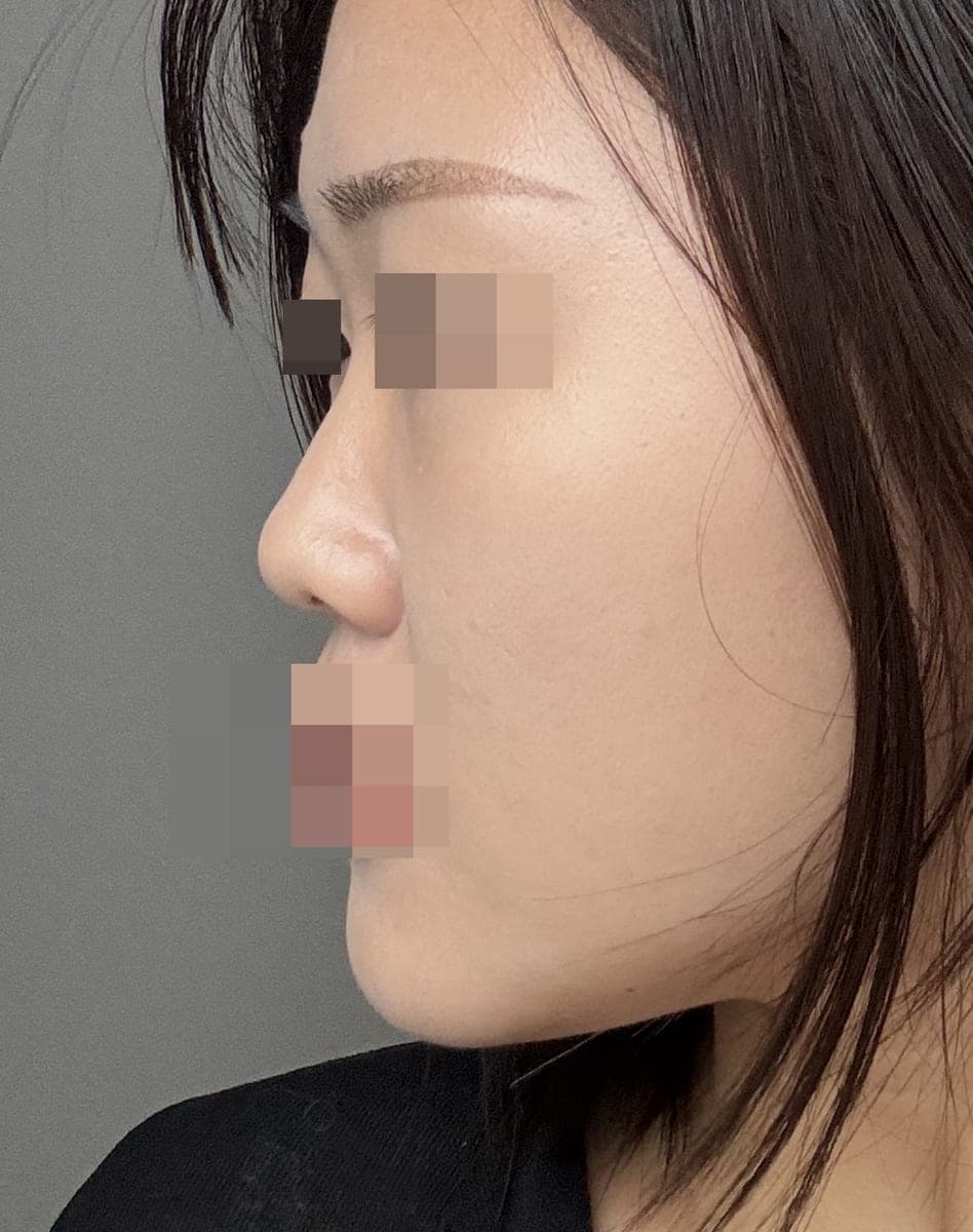 Kasus ujung bulbous dan ujung hidung sekaligus