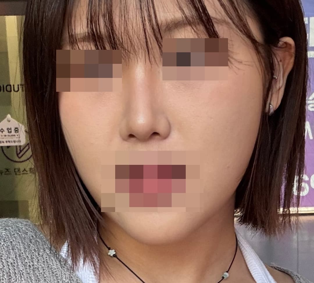 Kasus ujung bulbous dan ujung hidung sekaligus
