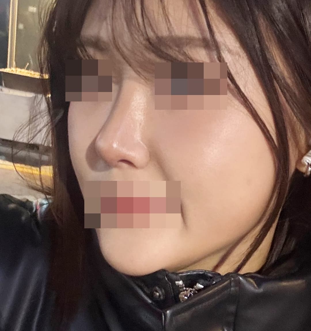 Kasus ujung bulbous dan ujung hidung sekaligus