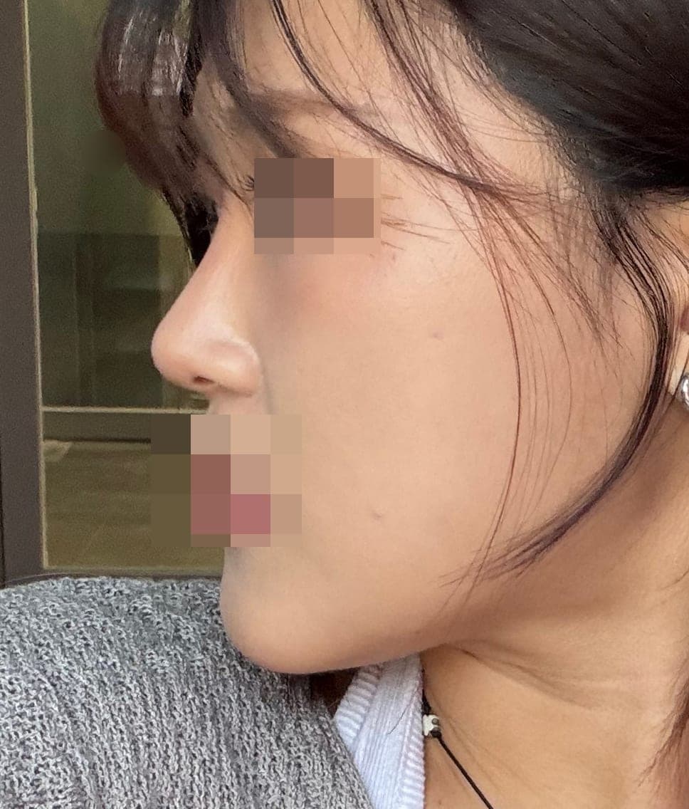 Kasus ujung bulbous dan ujung hidung sekaligus