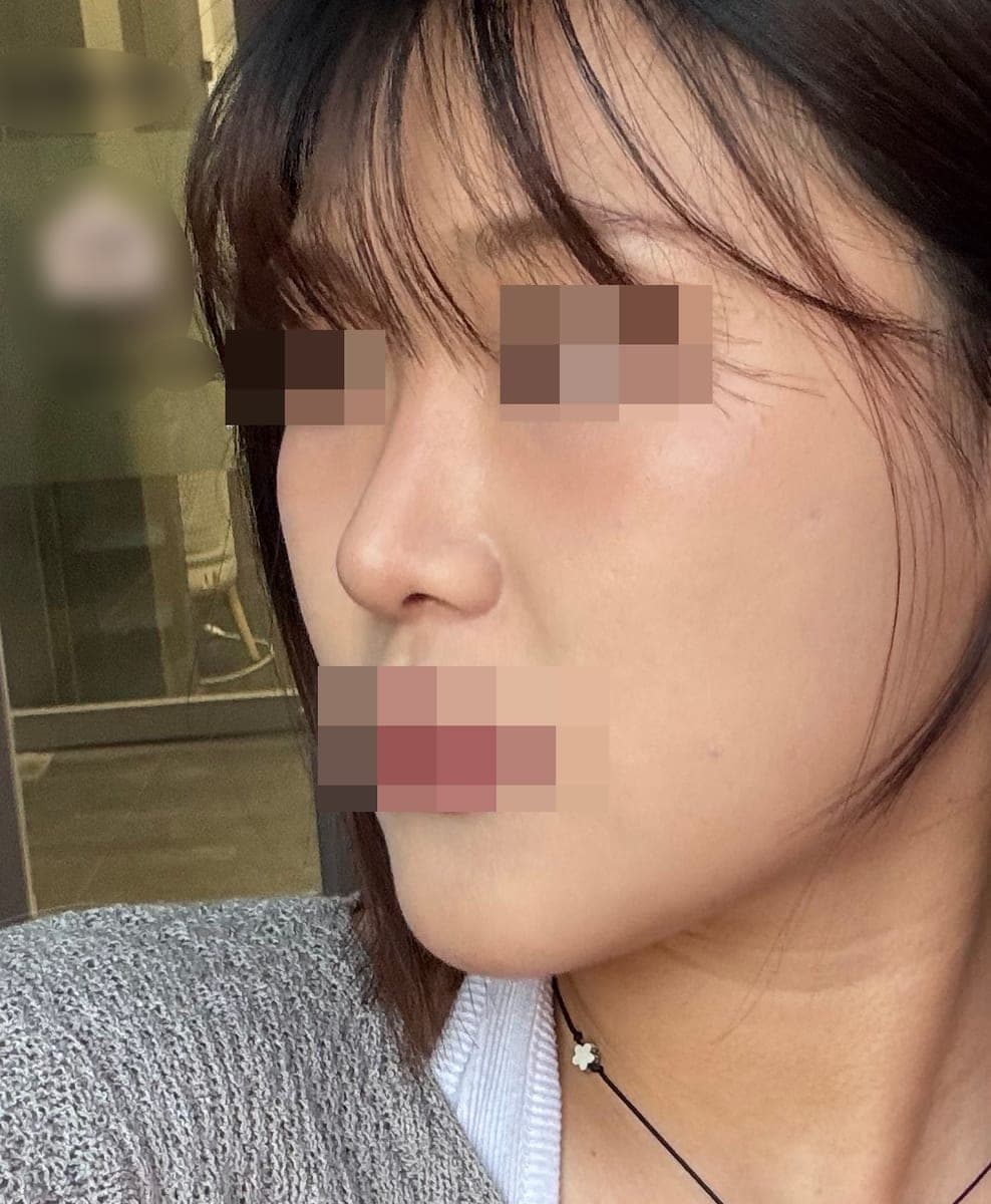 Kasus ujung bulbous dan ujung hidung sekaligus